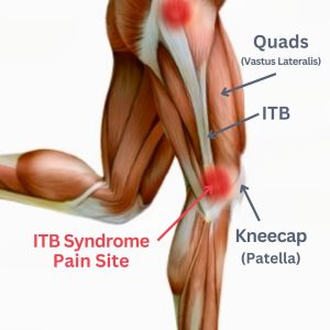 What Is IT Band Syndrome? Symptoms, Causes and Rehab Guide