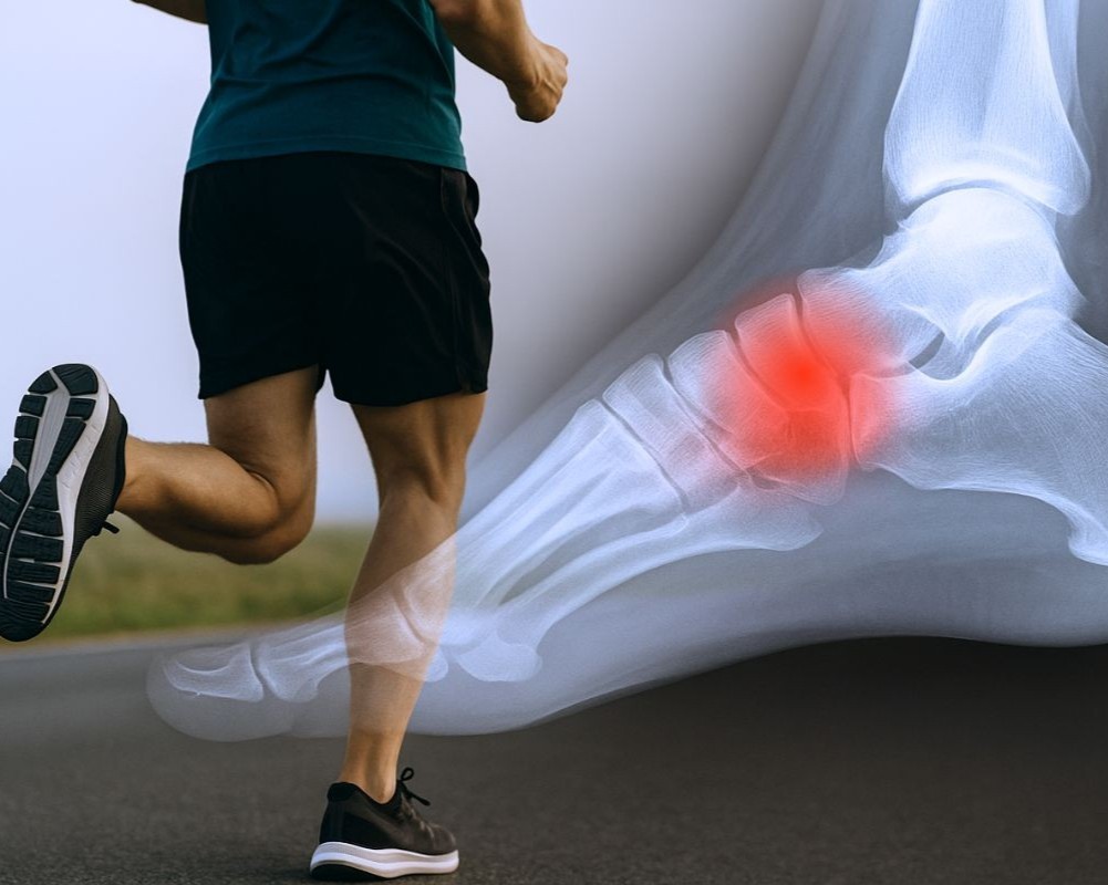 How to treat navicular bone stress injury in runners.