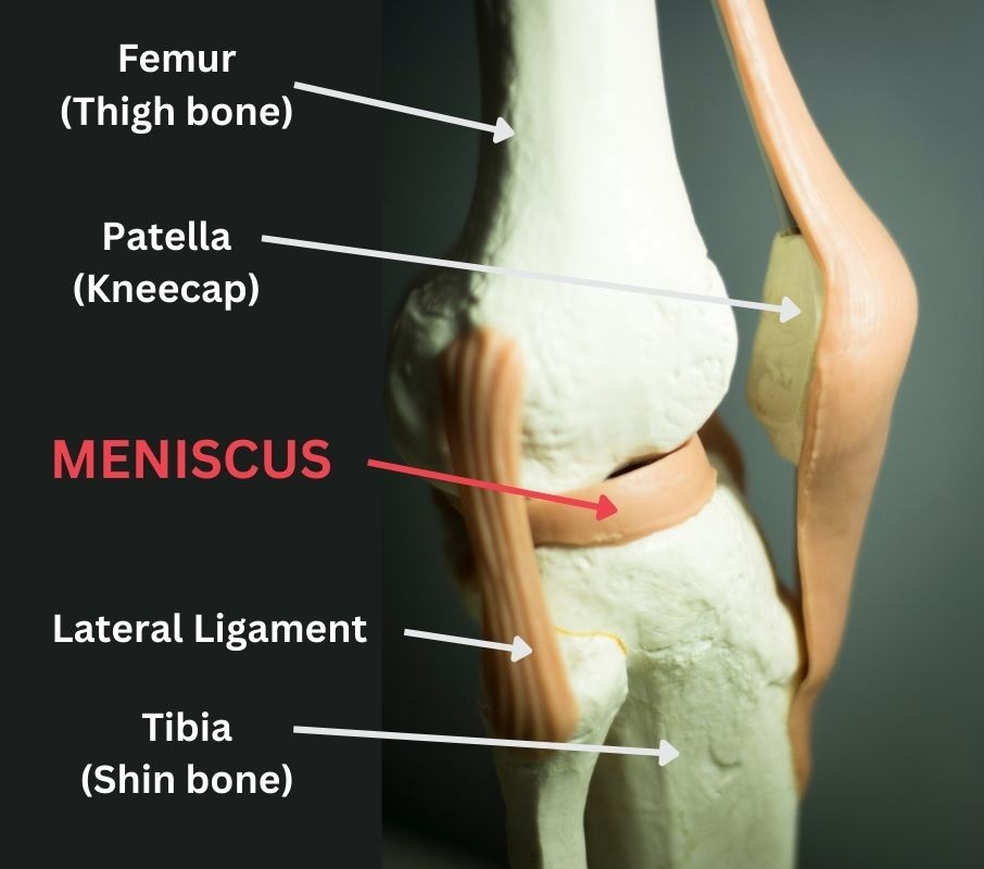 What is a meniscus tear in the knee?
